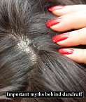 Important Myths Behind Dandruff